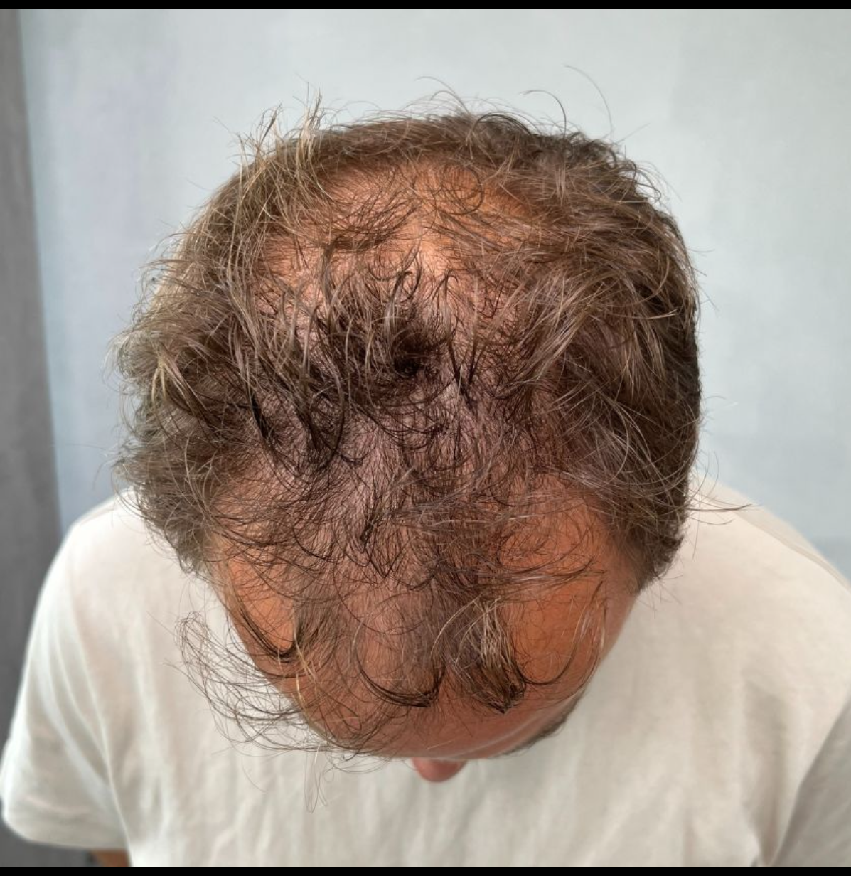Diffuser Haarausfall: Ursachen erkennen und effektiv behandeln. Erfahre, was hinter gleichmäßigem Haarverlust steckt und welche Tipps wirklich helfen.